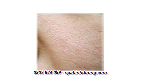 Lỗ chân lông to là một trong những hậu quả của việc chăm sóc da không đúng cách