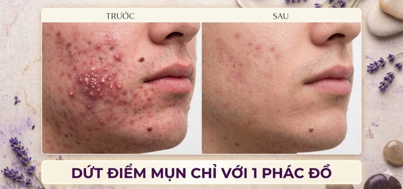 Trị mụn hiệu quả bình dương