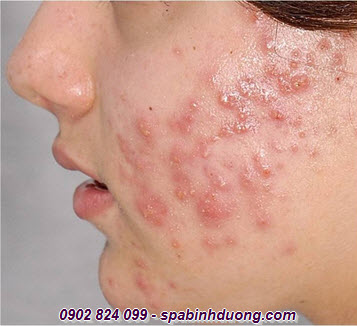 Mụn bọc là loại mụn gây rất nhiều tổn thương cho da