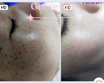 Liệu trình Điều trị nám da hiệu quả sau 10 ngày