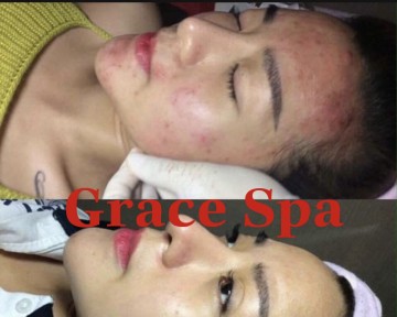 KHÁCH HÀNG TRỊNH LAN VY  34 TUỒI  SỐNG TẠI LINH XUÂN  - TP THỦ ĐỨC ĐIỀU TRỊ MỤN THÂM SAU 2 TUẦN