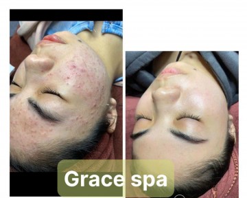 Nơi Lấy Nhân Mụn Uy Tín Tại Dĩ An Bình Dương