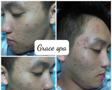 Trị Mụn Trứng Cá Ở Đâu Hiệu Quả Tại Bình Dương