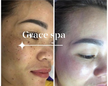 Kết quả Trị nám da chân sâu đốm nâu  hiệu quả sau 10 ngày tại  Grace spa - bình dương